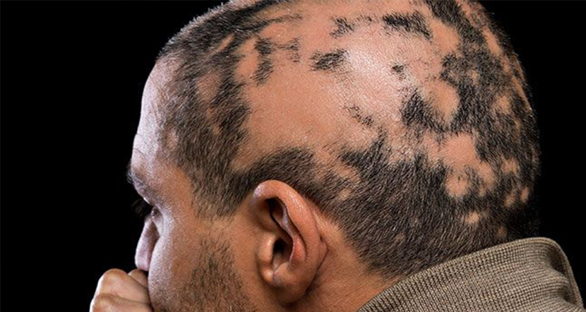alopeciya.jpg