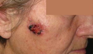 Клінічні прояви передраків і раку шкіри