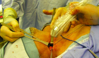 Операція Крайля (радикальна лімфодисекція шиї)
