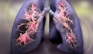 Чому розвивається рак легень, фактори ризику,симптоми та лікування.