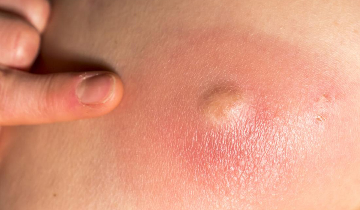 Гнійні захворювання шкіри: причини виникнення та методи лікування