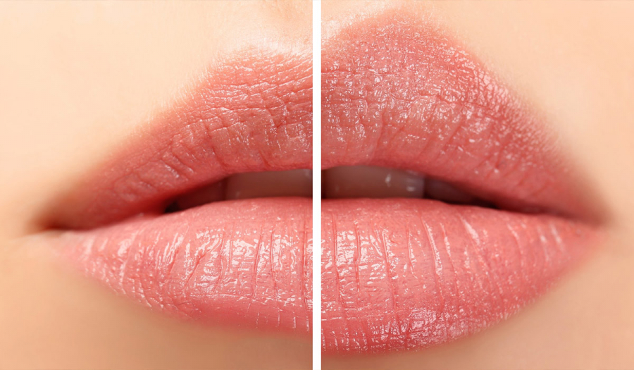 Несиметричні губи – що робити?