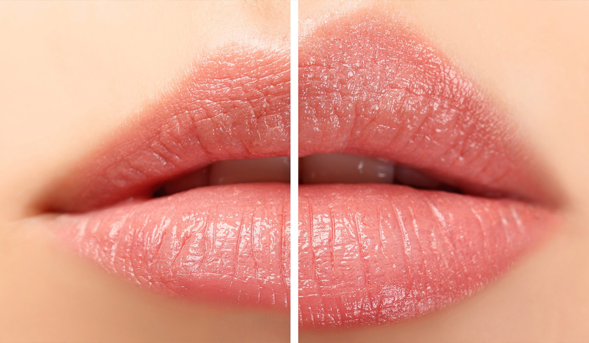 Несиметричні губи – що робити?